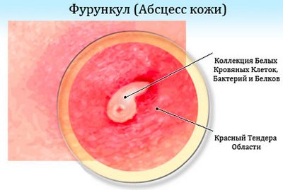 Фурункул