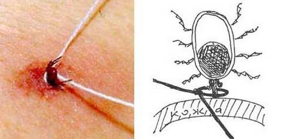 вытаскивание клеща