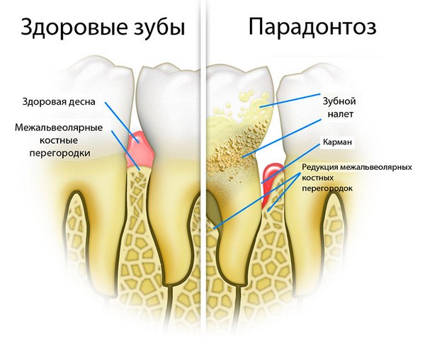 пародонтоз