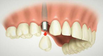 Имплантация зубов