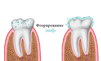 фторирование зубов