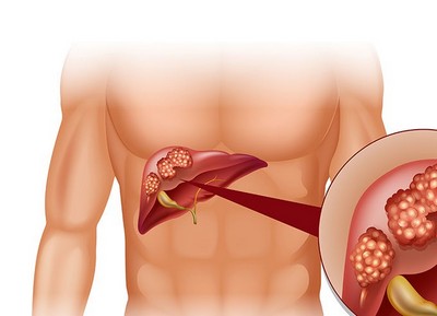 Рак печени