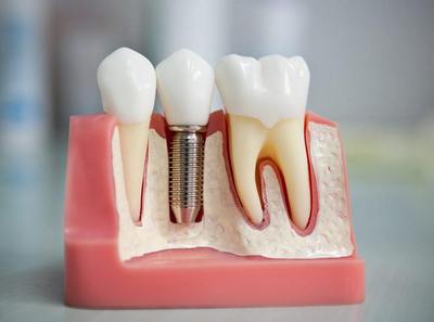 протезування зубів
