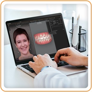 Елайнери Invisalign