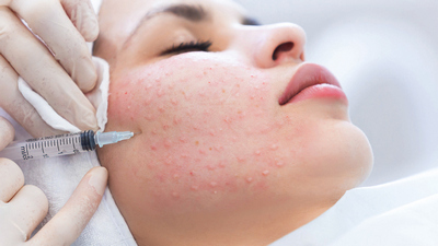 мезотерапия